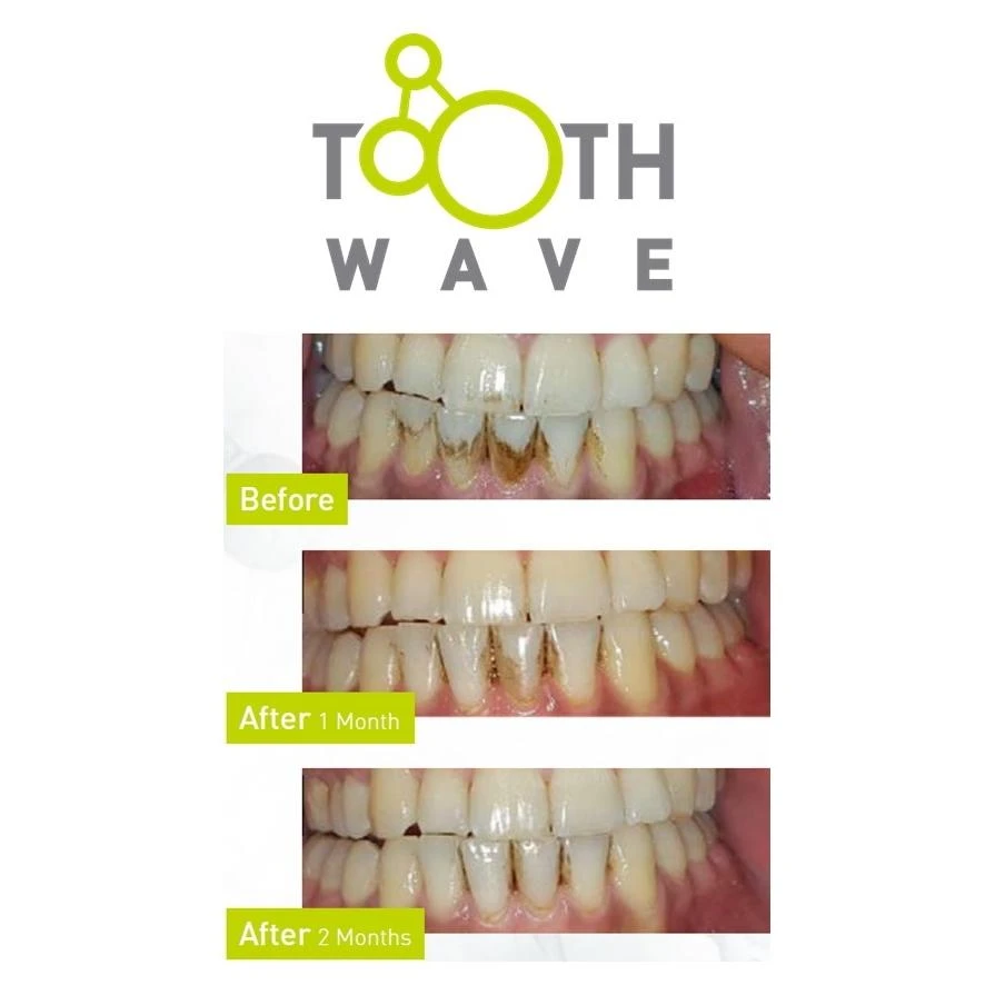 Silk'n ToothWave dantų valymo efektyvumo rezultatai