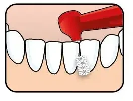 TePe Angle