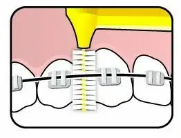 TePe Angle