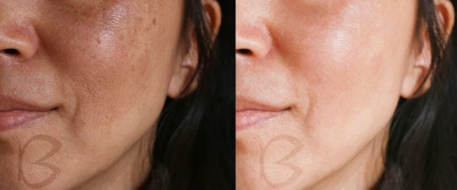 Ultragarsinė veido valymo mentelė Beautifly B-Scrub Young aprašymas - Prekės nuotrauka